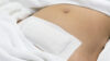 Person mit abgedeckter Narbe am Bauch, Veranschaulichung für operative Myomentfernung per Bauchschnitt